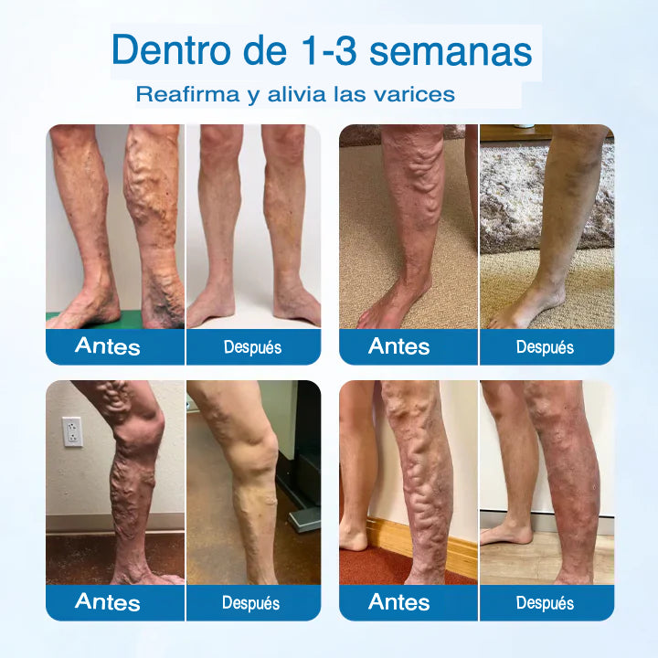 Timilk® VeinGuard™ Spray x 1 (30 ml) — Alivio y soporte microcirculatorio 🌿