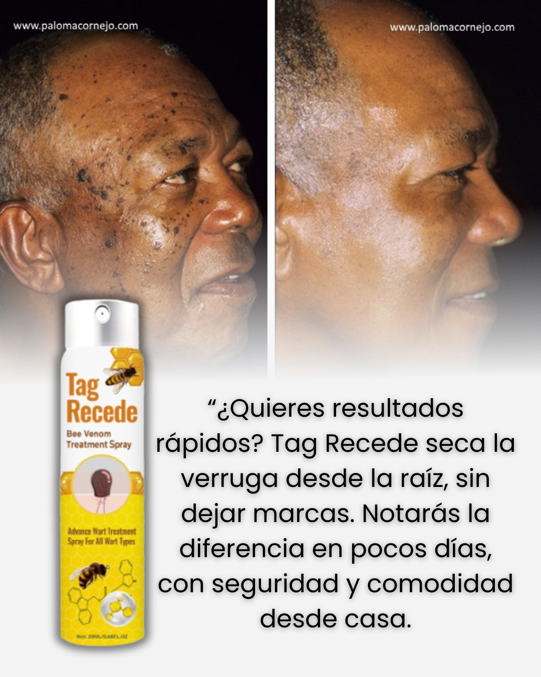 Elimina Verrugas Pro™ Pague 1 lleve 2  (0.7 fl oz) – Piel libre y segura 🌿